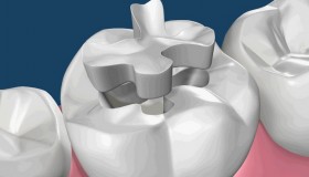 Esthetic dental restorations