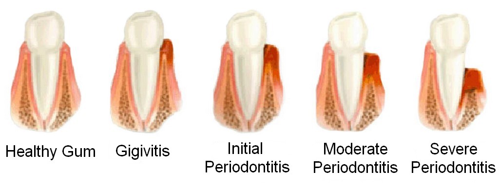 Periodontology in Pérez Zeledón | Southern Zone Costa Rica